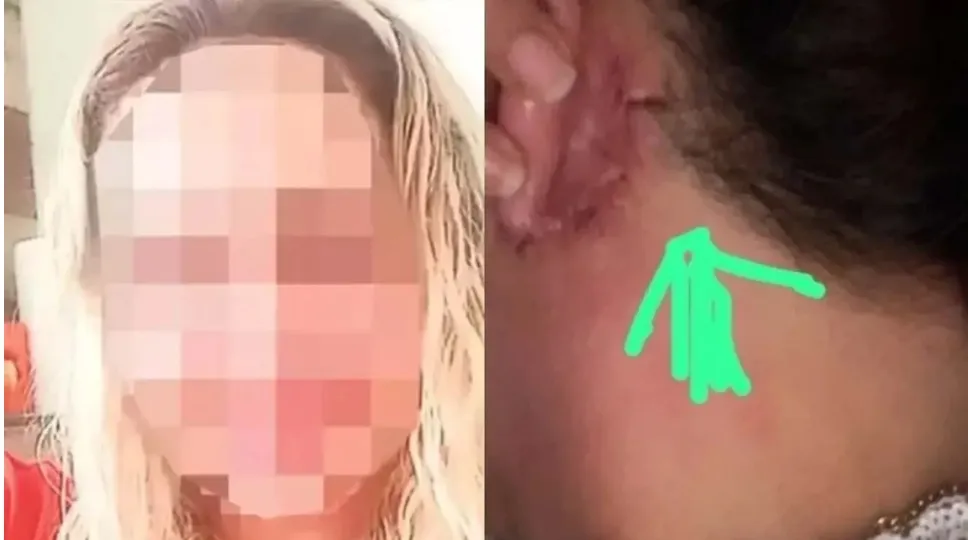  Estetik Operasyon Faciası... Kulağı Yüze Diktiler...